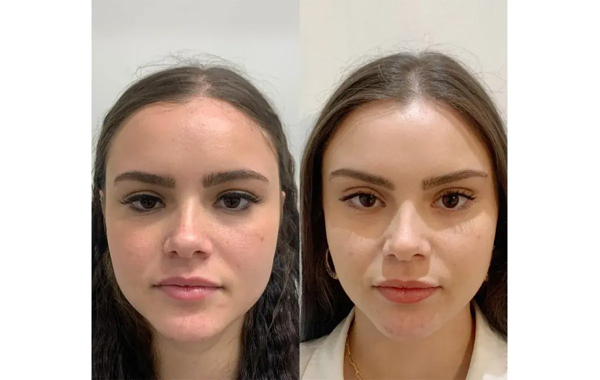 عکس قبل و بعد لیفت ابرو با نخ