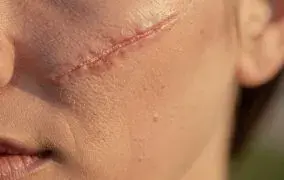 بهترین پماد برای زخم صورت