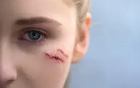 درمان سریع زخم تازه صورت