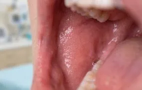 کمبود کدام ویتامین باعث خشکی دهان می‌شود